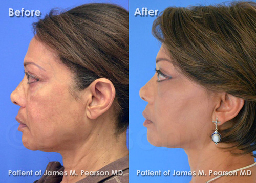 Pearson Cheek Lift Photos