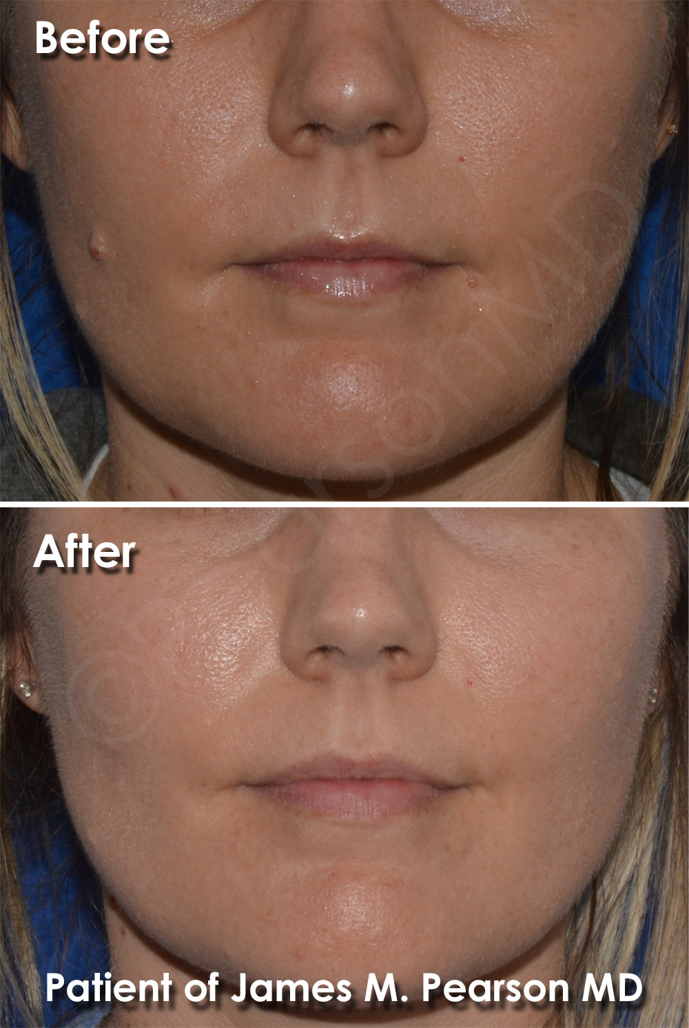 Mole Removal Photos Before & After Dr. James Pearson