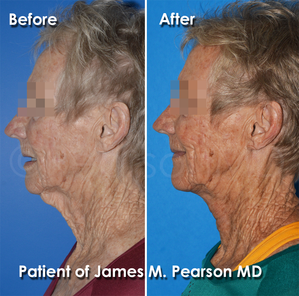 Pearson Plastic Surgery