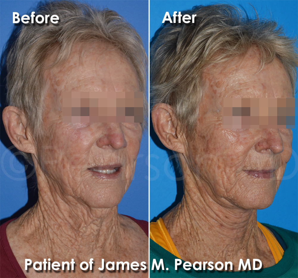 Pearson Plastic Surgery