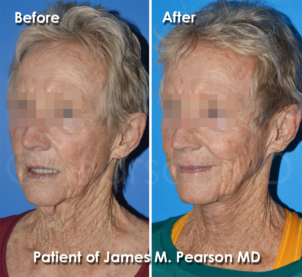 Pearson Plastic Surgery