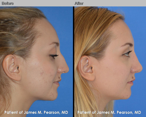 Dr. Pearson Rhinoplasty Before & After Photo Photos Dr. Pearson Rhinoplasty