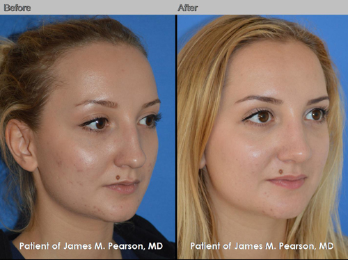 Dr. Pearson Rhinoplasty Before & After Photo Pearson Plastic Surgery