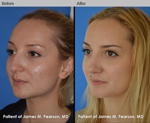 Dr. Pearson Rhinoplasty Before & After Photo Photos Pearson Rhinoplasty