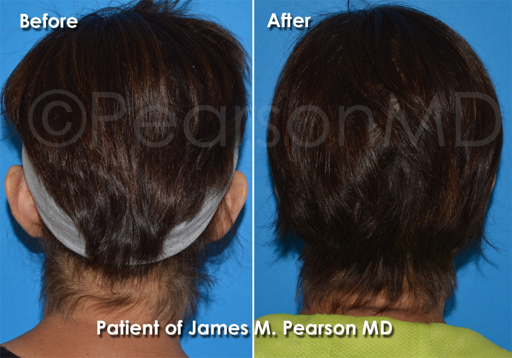 Otoplasty Ear Shaping Photos