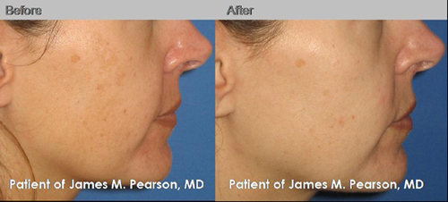 Skin Treatment Photos - Dr. Pearson