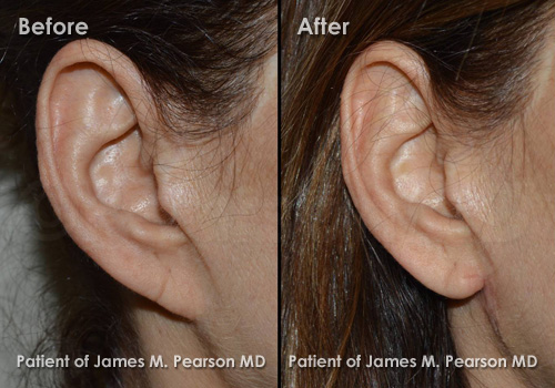 Photo Pearson Pixie Ear Surgery