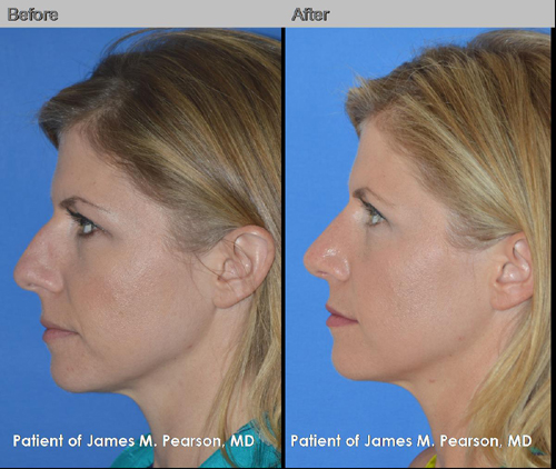 Rhinoplasty Photos - Dr. James Pearson Facial Plastic Surgery Photos Pearson Rhinoplasty