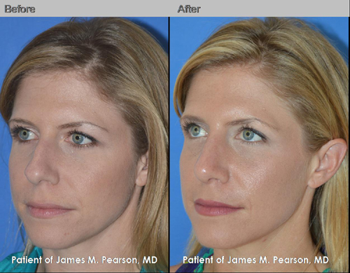 Rhinoplasty Photos - Dr. James Pearson Facial Plastic Surgery Photos Pearson Rhinoplasty