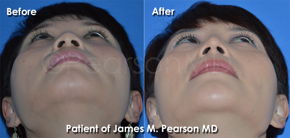 Photos Dr. Pearson Rhinoplasty