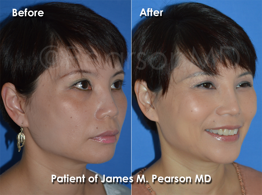 Photos Dr. Pearson Rhinoplasty