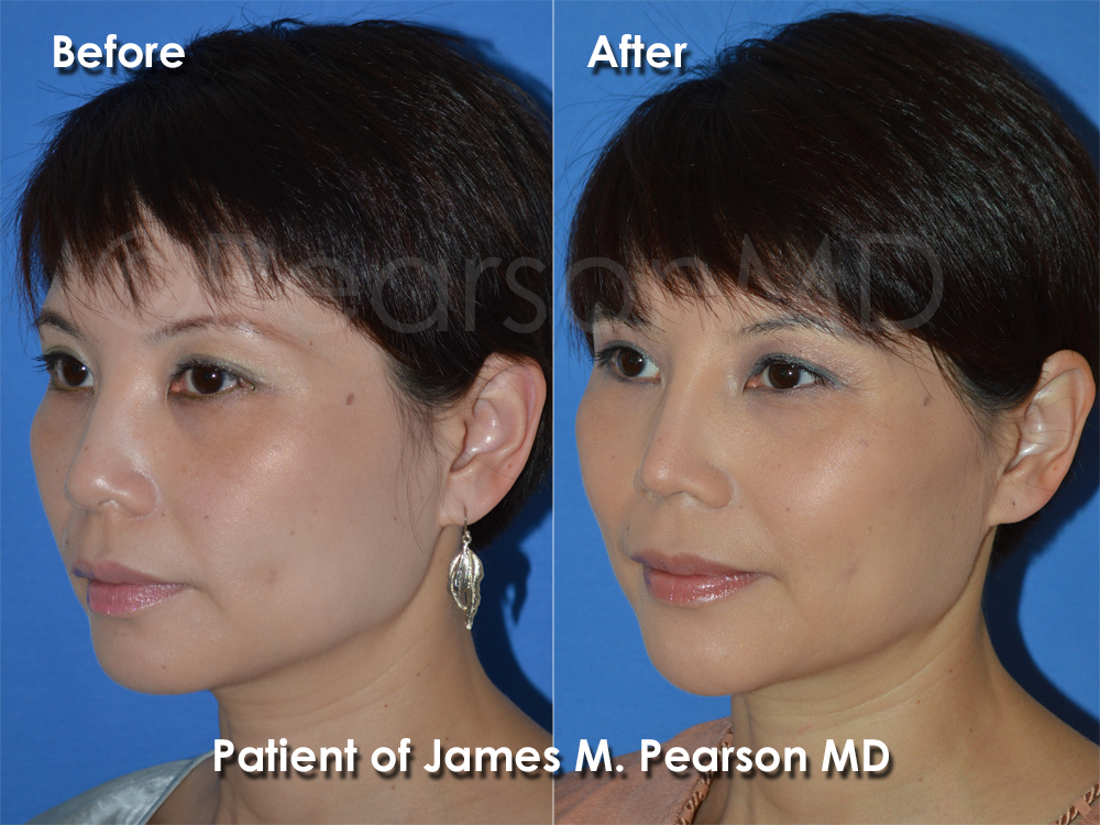Pearson Plastic Surgery