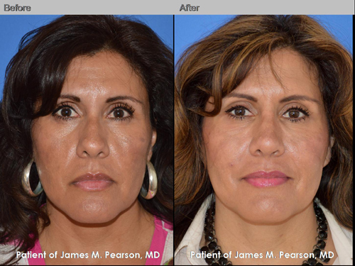 Photo Pearson Rhinoplasty Nose Reshaping Surgery