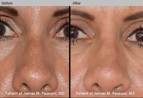 Photo Pearson Rhinoplasty Nose Reshaping Surgery