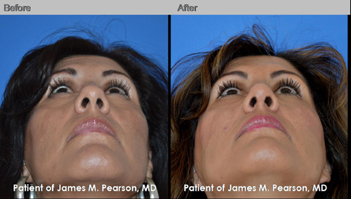 Photo Pearson Rhinoplasty Nose Reshaping Surgery