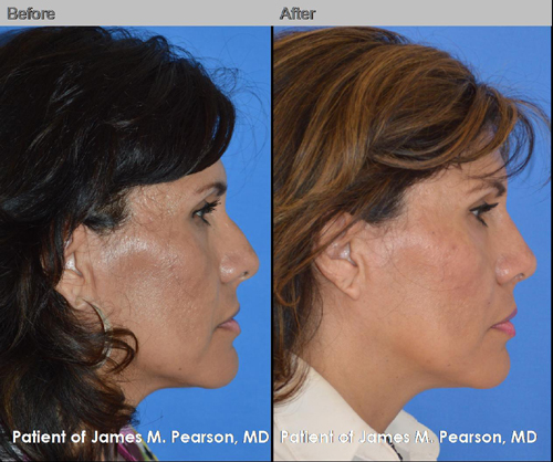 Photo Pearson Rhinoplasty Nose Reshaping Surgery