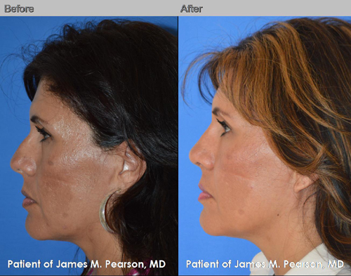 Photo Pearson Rhinoplasty Nose Reshaping Surgery