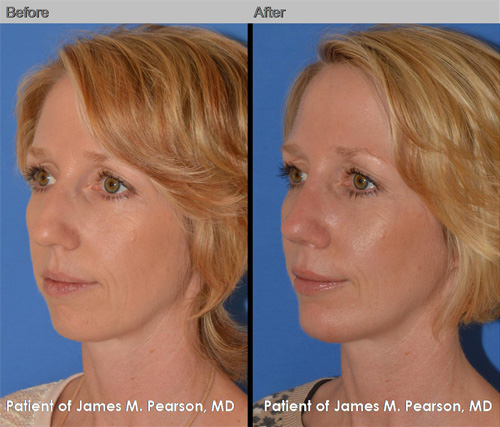 Pearson Rhinoplasty