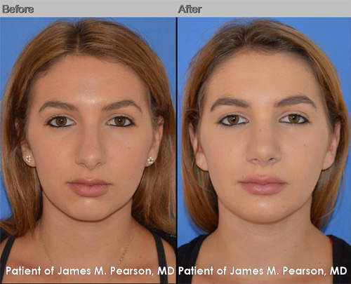 Rhinoplasty - Dr. James Pearson Facial Plastic Surgery