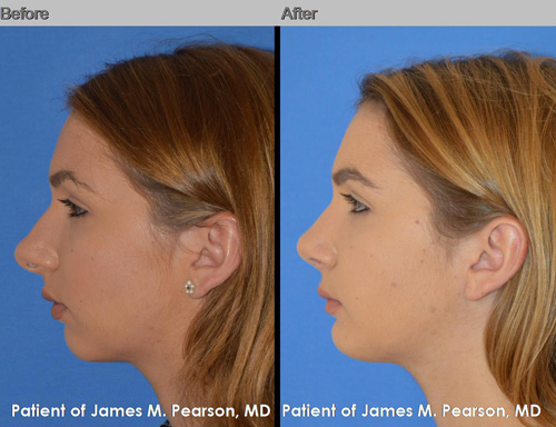 Dr. Pearson Chin Implant Photos