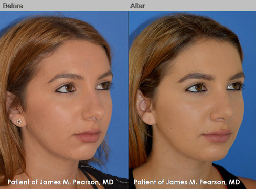 Rhinoplasty - Dr. James Pearson Facial Plastic Surgery