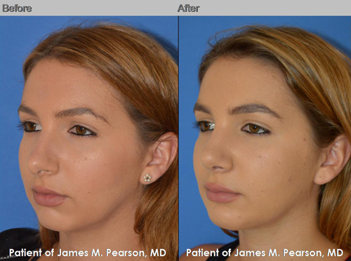 Rhinoplasty - Dr. James Pearson Facial Plastic Surgery