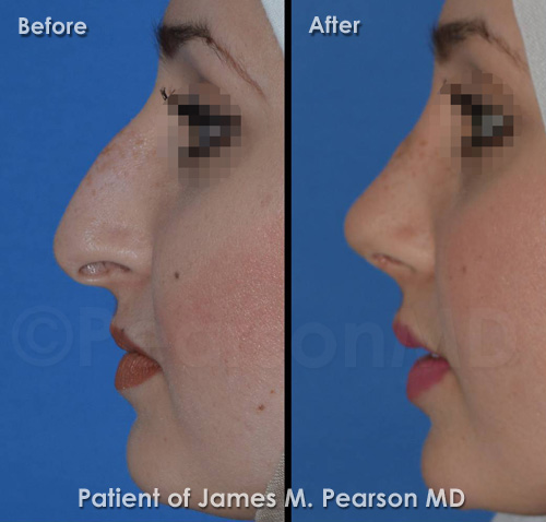 Pearson Rhinoplasty Nosejob Photos