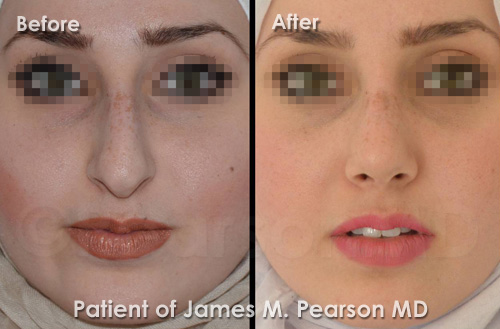 Pearson Rhinoplasty Nosejob Photos