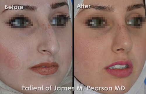 Pearson Rhinoplasty Nosejob Photos