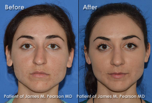 Pearson Rhinoplasty Photos