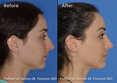 Beverly Hills Rhinoplasty Photos
