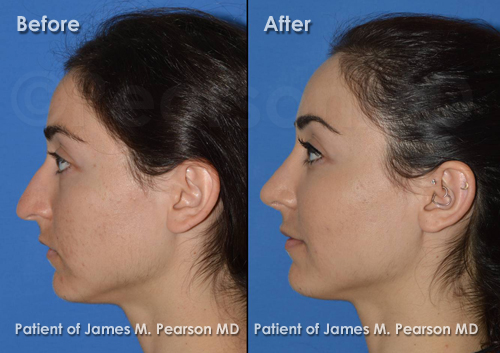 Pearson Nose Surgery Photos