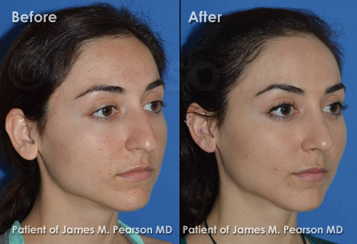 Los Angeles Rhinoplasty Photos