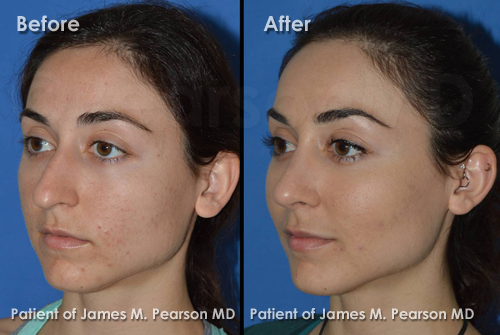 Pearson Nasal Surgery Photos