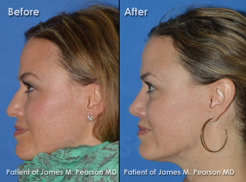 Dr. Pearson Rhinoplasty photos