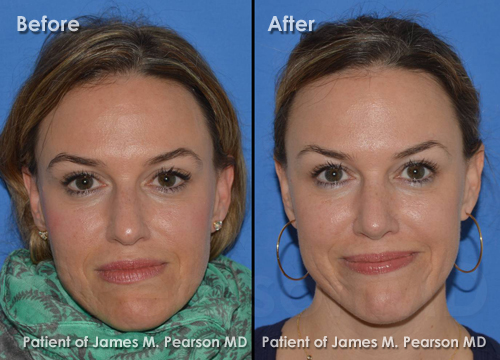 Pearson Rhinoplasty photos