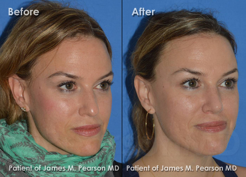 Dr. Pearson Rhinoplasty photos