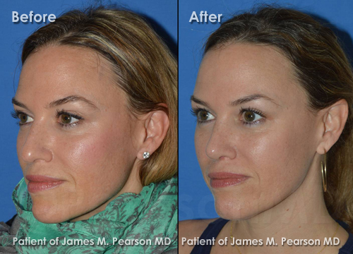 Pearson Rhinoplasty photos