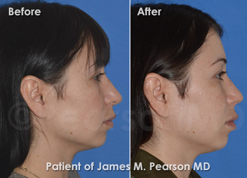 Pearson Rhinoplasty photos