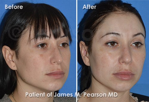 Pearson Rhinoplasty photos