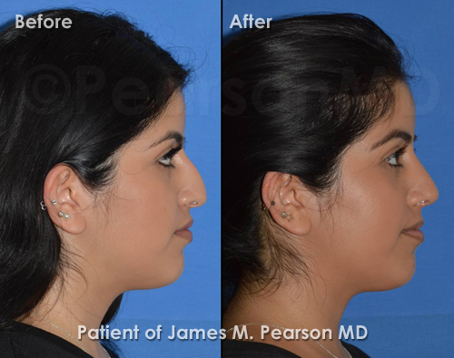 Los Angeles Rhinoplasty photos