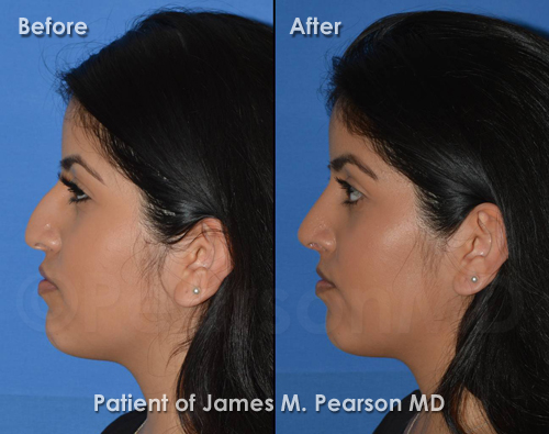 Pearson Rhinoplasty photos