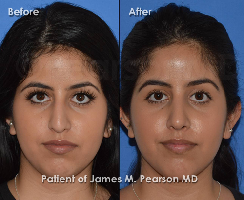 Torrance Rhinoplasty photos