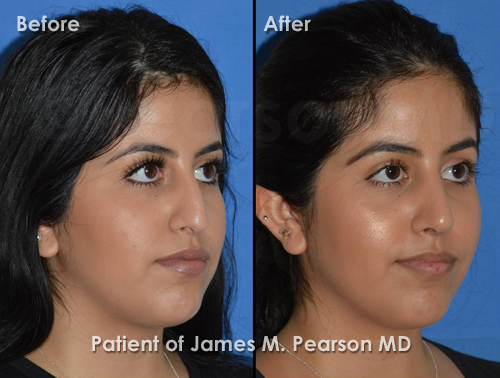 Pearson Rhinoplasty photos
