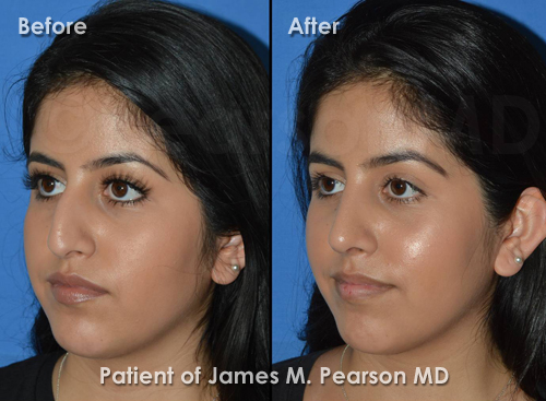 Manhattan Beach Rhinoplasty photos