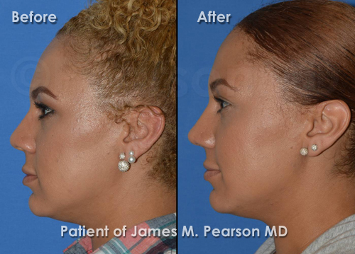 Pearson Rhinoplasty photos