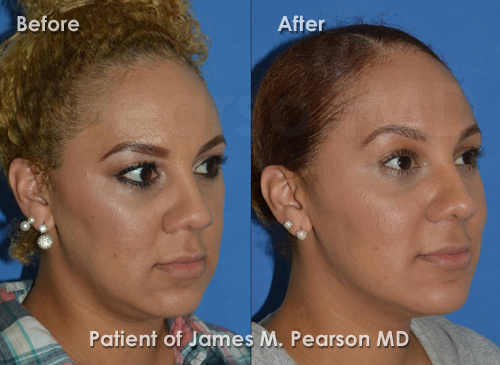 Los Angeles Rhinoplasty photos