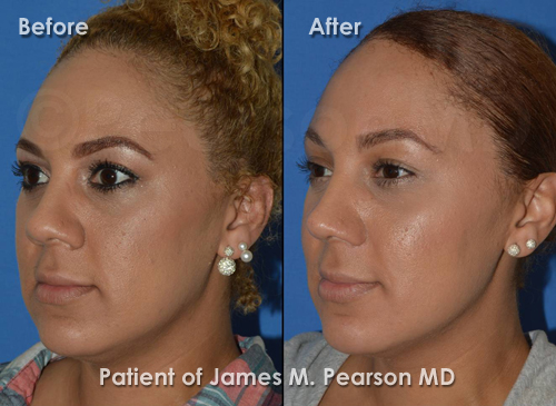 Pearson Rhinoplasty photos