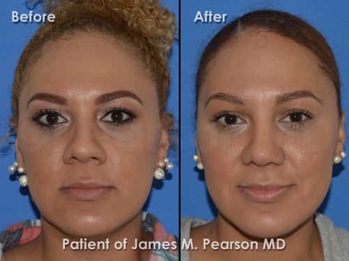 Pearson Rhinoplasty photos