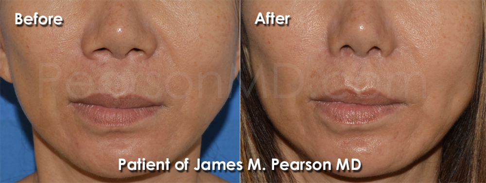 Pearson Nasal Surgery